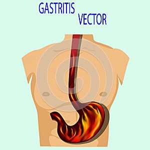 Gastritis