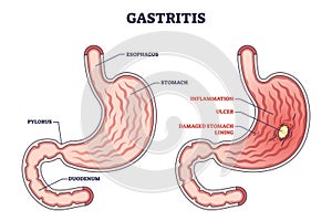 Gastritis as stomach lining inflammation illness and disease outline diagram