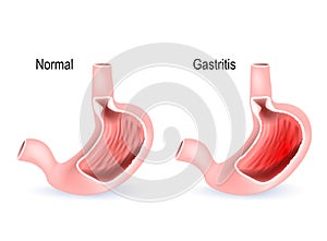 Gastritis. Cross section of two stomach