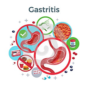 Gastritis disease symptoms causes medicine flat circular composition of healthy and affected stomach bacteria food vector