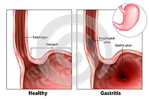 Gastritis and Esophageal ulcer