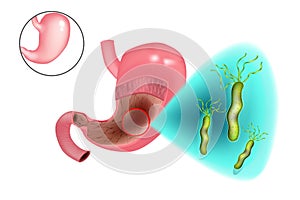 Gastritis Helicobacter pylori