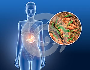 Gastritis, helicobacter pylori bacteria damaging mucus layer, medically accurate 3D illustration