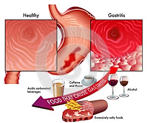 Gastritis photo