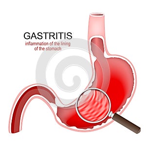 Gastritis. Stomach Inflammation photo