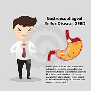 Gastro-Esophageal Reflux Disease GERD