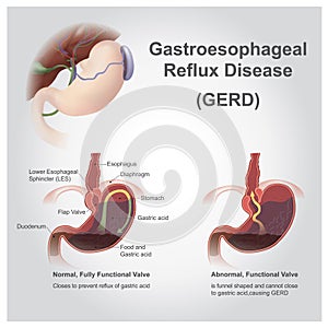 Gastro reflux