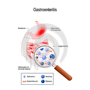 Gastroenteritis