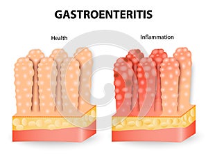 Gastroenteritis or infectious diarrhea photo
