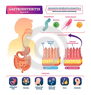 Gastroenteritis vector illustration. Labeled stomach inflammation scheme