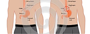 Gastroesophageal reflux desease. Gerd stomach in a human body vector illustration