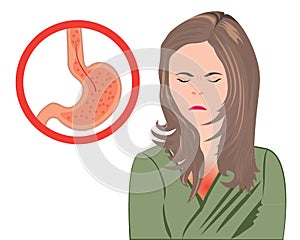 Gastroesophageal reflux desease. Gerd stomach in a human body vector illustration photo
