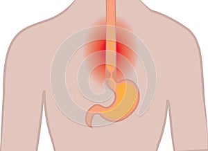 Gastroesophageal reflux desease. Heartburn Gerd stomach in a human body vector illustration