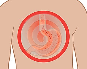 Gastroesophageal reflux desease. Heartburn Gerd stomach in a human body vector illustration