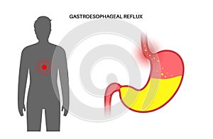 Gastroesophageal reflux disease