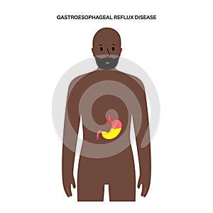 Gastroesophageal reflux disease