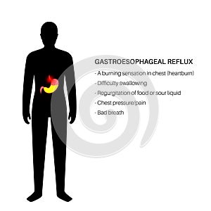 Gastroesophageal reflux disease