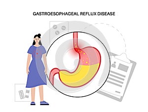 Gastroesophageal reflux disease