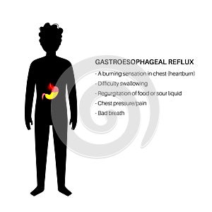 Gastroesophageal reflux disease