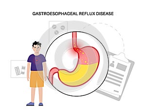 Gastroesophageal reflux disease