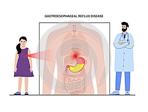 Gastroesophageal reflux disease