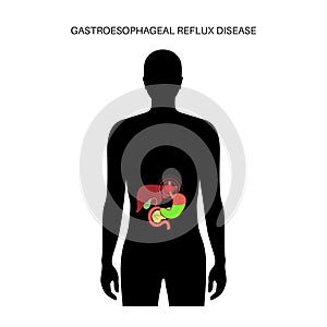 Gastroesophageal reflux disease