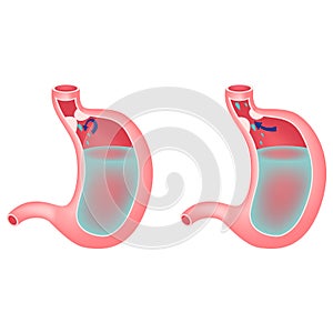 Gastroesophageal reflux disease.