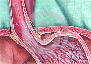 Gastroesophageal Reflux Disease