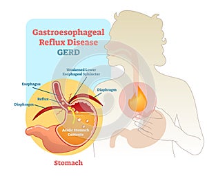 Gastroesophageal Reflux disease diagram scheme photo