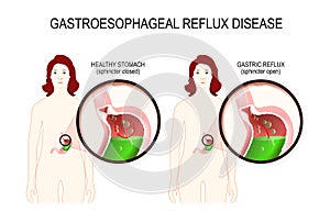 Gastroesophageal reflux disease. gerd