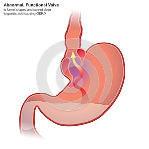 Gastroesophageal reflux disease GERD photo