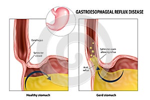 Gastroesophageal reflux disease photo