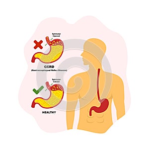 Gastroesophageal reflux disease GERD, illustration of the health condition of the human stomach.