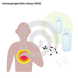 Gastroesophageal Reflux Disease or GERD with Treatment