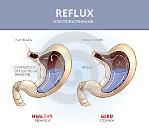 Gastroesophageal reflux disease. Healthy and sick photo