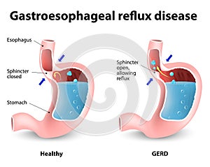 La acidez y el Reflujo Gastroesofágico (ERGE).