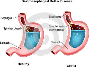 Gastroesophageal reflux disease photo