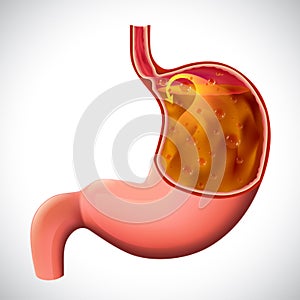 Gastroesophageal reflux disease illustration for medical and educational use