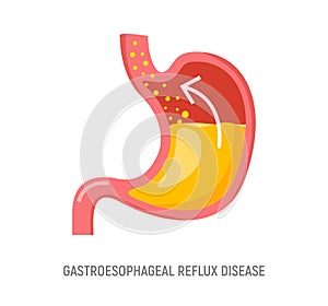 Gastroesophageal reflux disease. Stomach GERD heartburn esophagus medical illustration