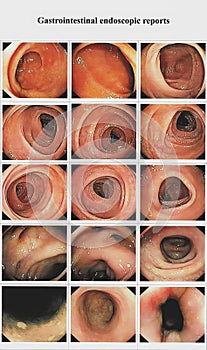 Gastrointestinal endoscopic examination image