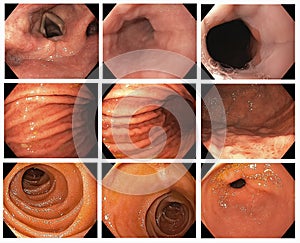Gastrointestinal endoscopic image of Esophagogastroduodenoscopy through esophagus stomach and duodenum with CLO test photo