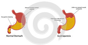 Gastroparesis vector illustration