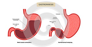 Gastroparesis anatomical poster