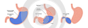 Gastroparesis anatomical poster