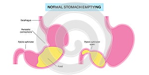 Gastroparesis anatomical poster