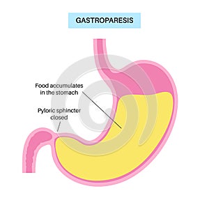 Gastroparesis anatomical poster