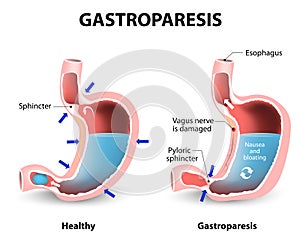 Gastroparesis