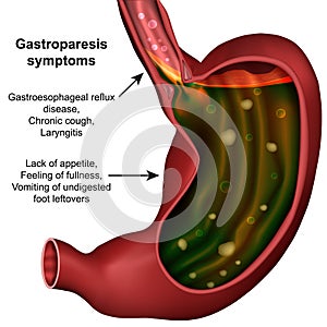 Gastroparesis stomach medical  illustration on white background photo