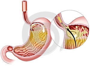 Gastrophageal reflux disease (GERD). Illustration