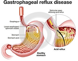 Gastrophageal reflux disease (GERD). Illustration. Labeled